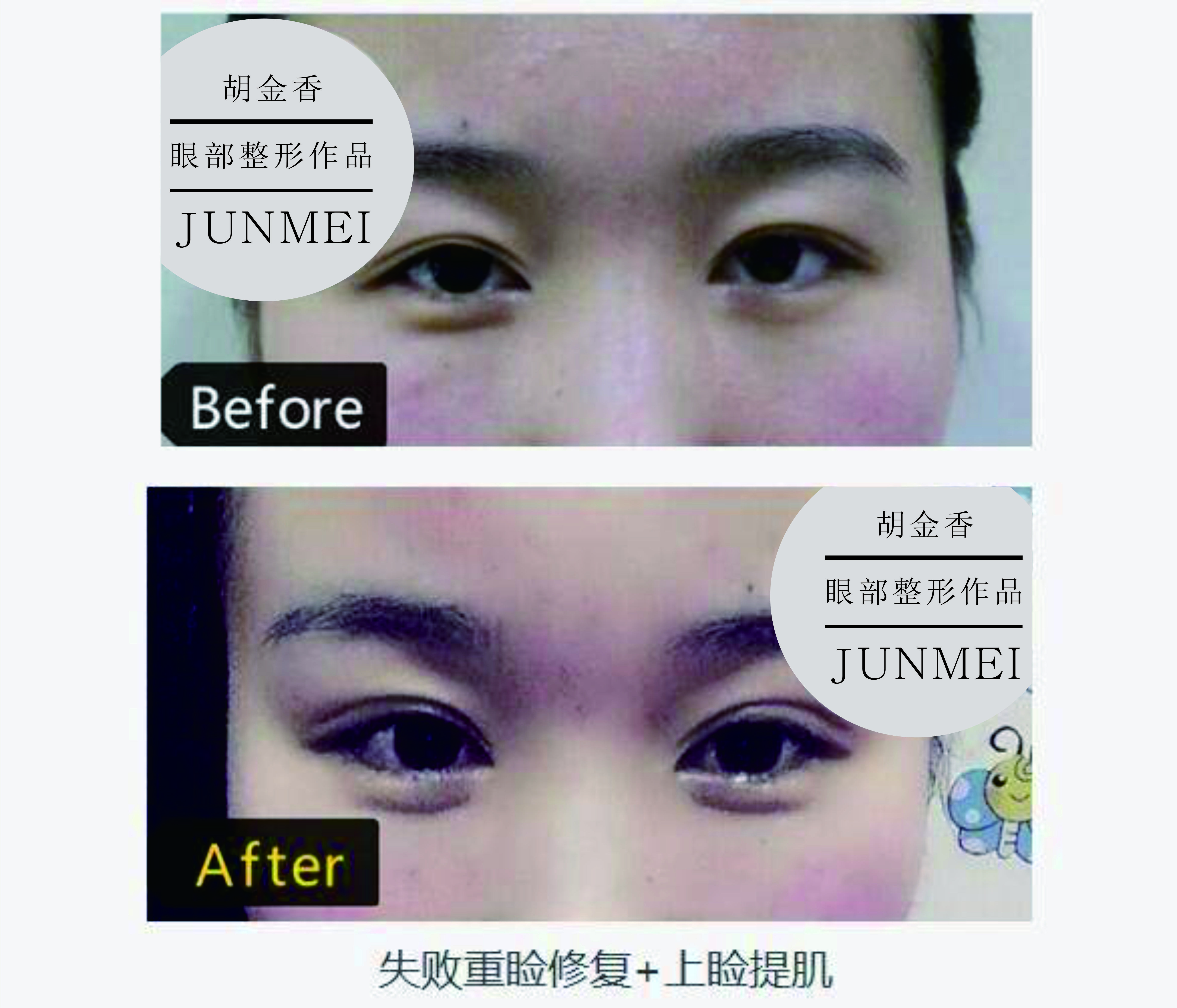 两年前做的双眼皮全切手术 目前两边宽 新氧美容整形