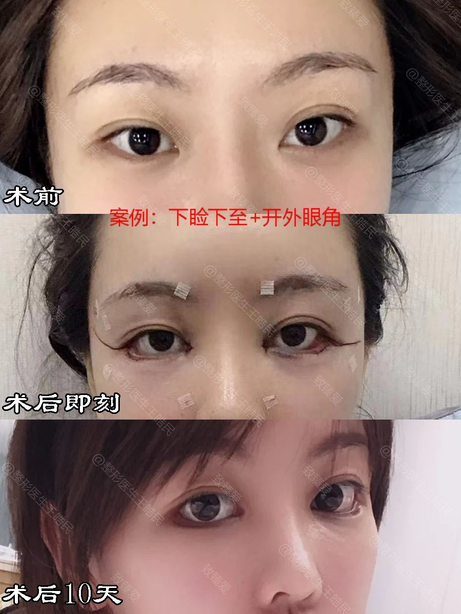 下睑下至这么火,医生为什么不给我做?