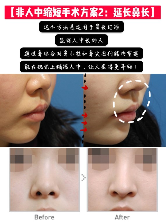 不做人中缩短手术,就能缩短人中