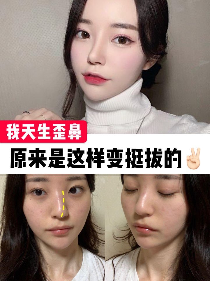 需要做歪鼻矫正的仙女们都点进来看看 昨晚回家的路 圈子 新氧美容整形