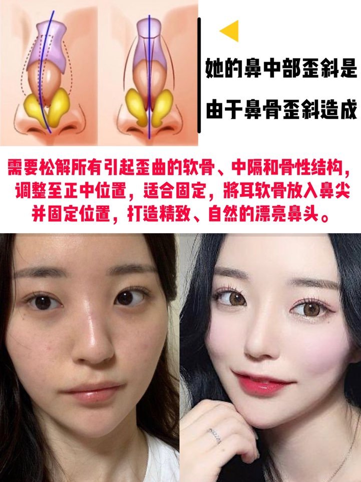 需要做歪鼻矫正的仙女们都点进来看看 昨晚回家的路 圈子 新氧美容整形