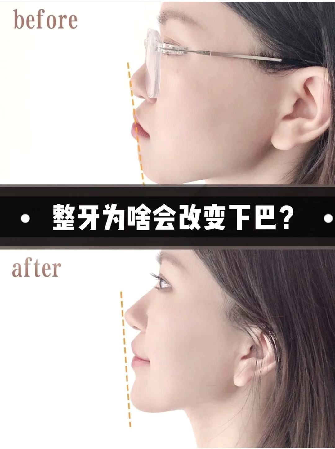 矫正牙齿为什么会改变下巴