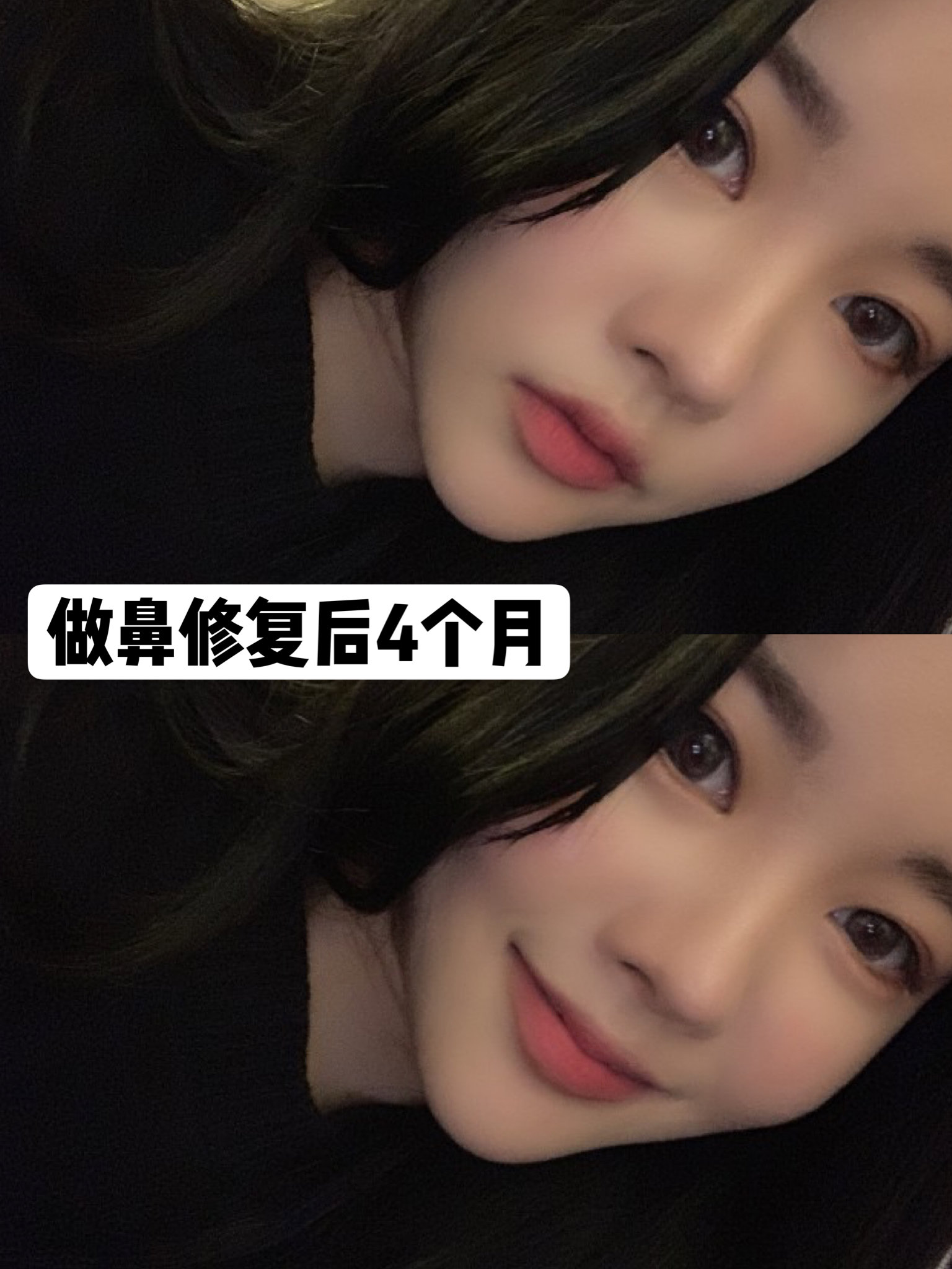 鼻修复成功案例分享值得借鉴