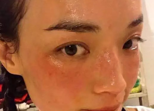 遇到换季过敏的情况,切勿立马去做光子嫩肤!