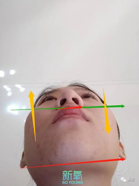 歪的不是嘴,其实还是骨头,加上妹子的下颌很内收,下巴又窄又小,所以不