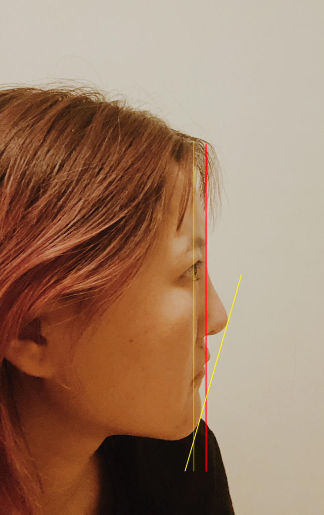 侧脸最丑求改善 新氧美容整形