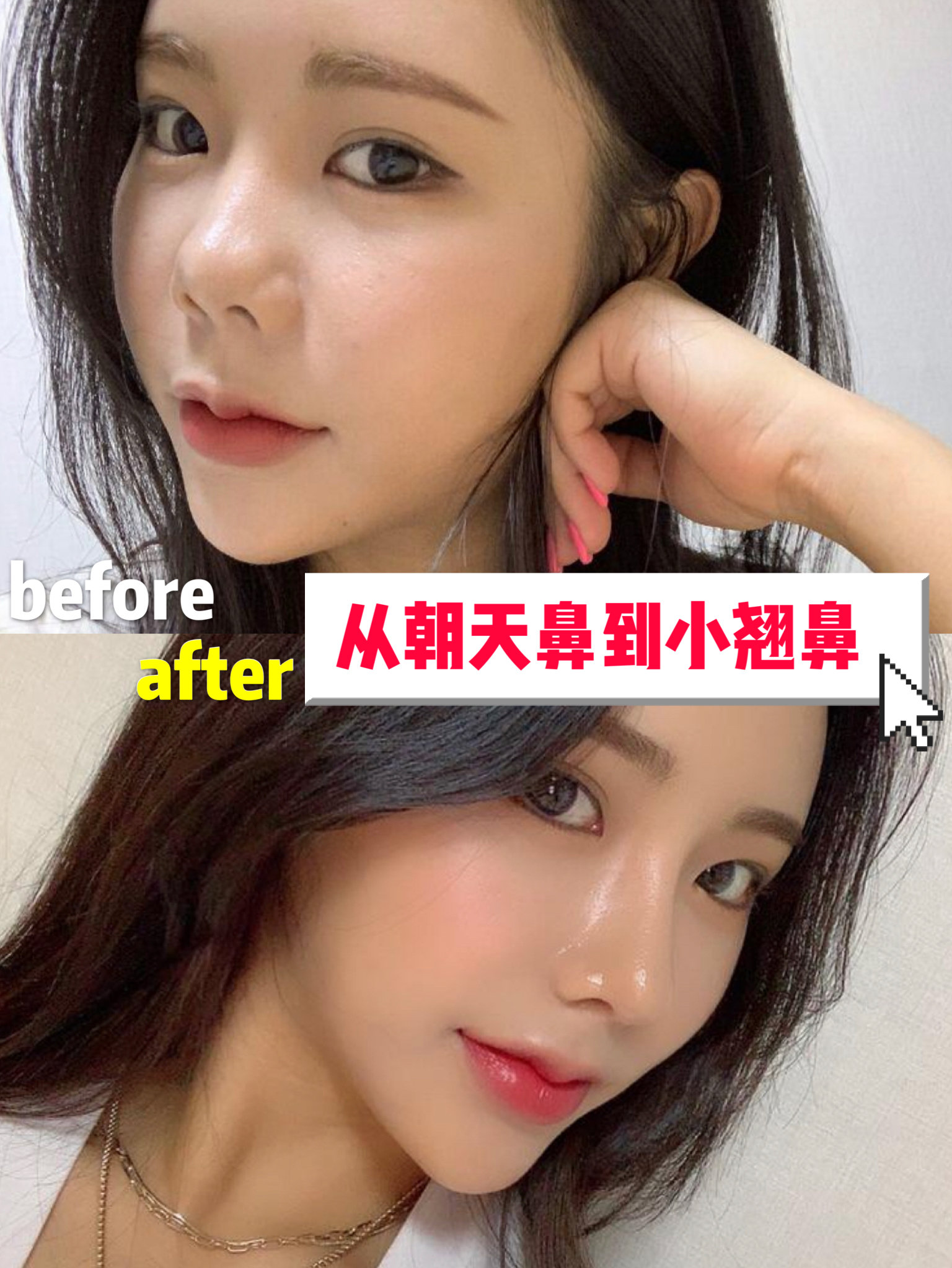 短鼻延长矫正朝天鼻过程分享:和猪鼻子说说拜拜