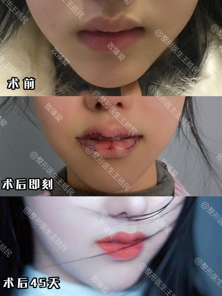 m唇手术设计图片