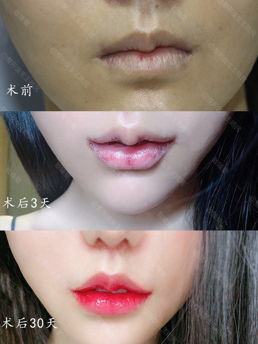 感觉自己上嘴唇有点厚,想变薄点是单纯做手术改薄还是做m唇呢?