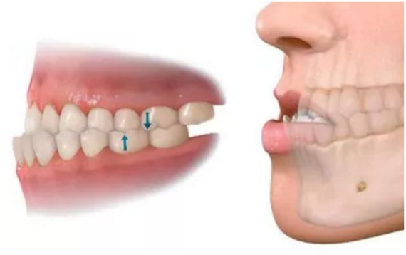 经常口腔溃疡只是因为缺维生素b吗要警惕是你的牙齿咬合出现了问题哦