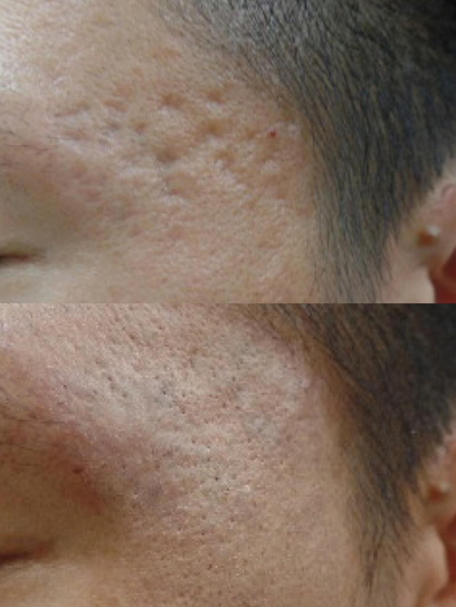 欧尼带你变美|自体真皮再生术,这才是痘坑痘印救星