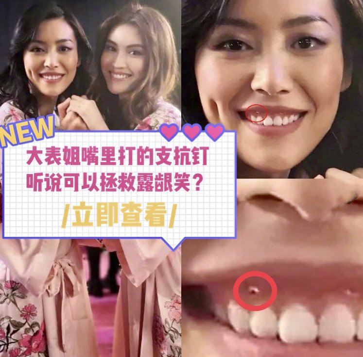 大表姐嘴里打的支抗钉听说可以拯救露龈笑