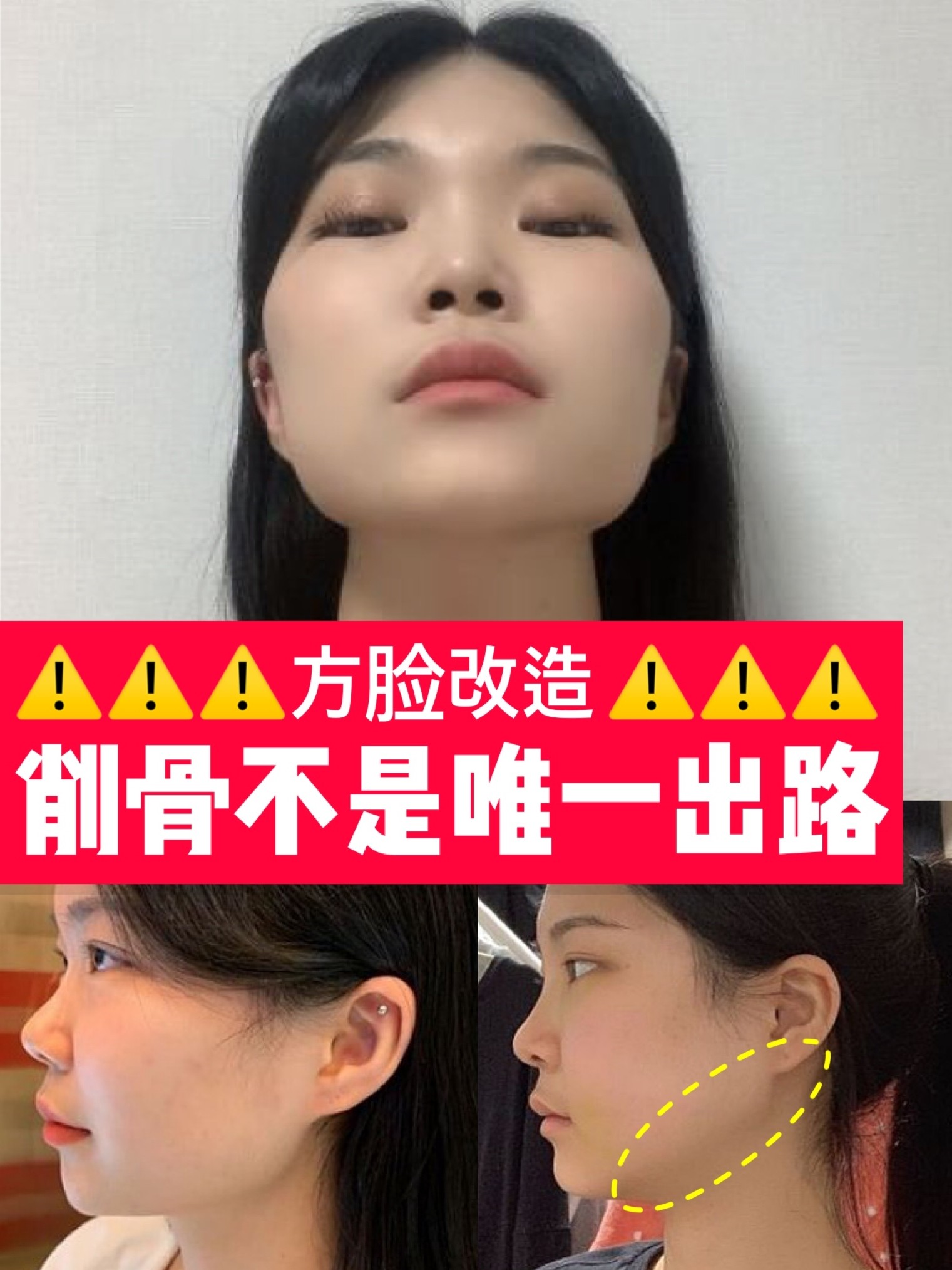 方形脸,下半脸宽,该不该削骨?