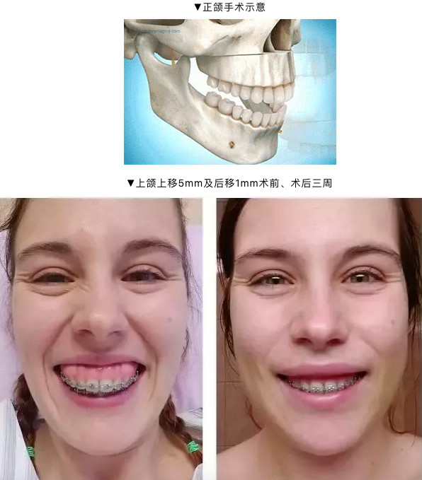 纠结了好久终于去切了牙龈!