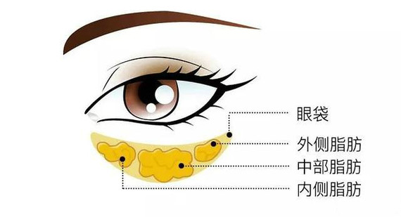 卧蚕的本质是眼轮匝肌 能让眼睛显得更大 更楚楚动人 而眼袋则