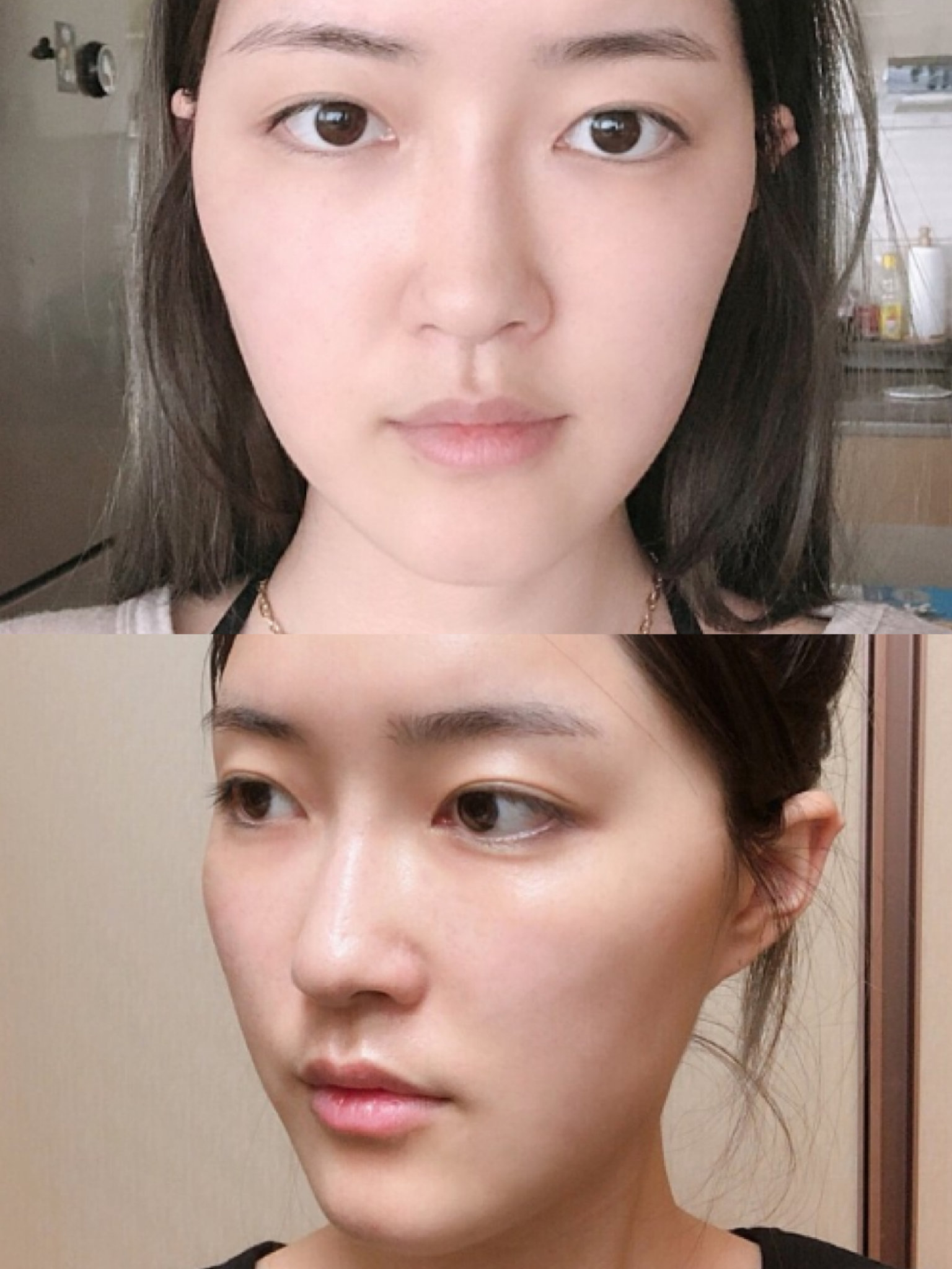 脸型真实案例:被院长改造后简直脸小一半-想拥有拥_圈子-新氧美容整形