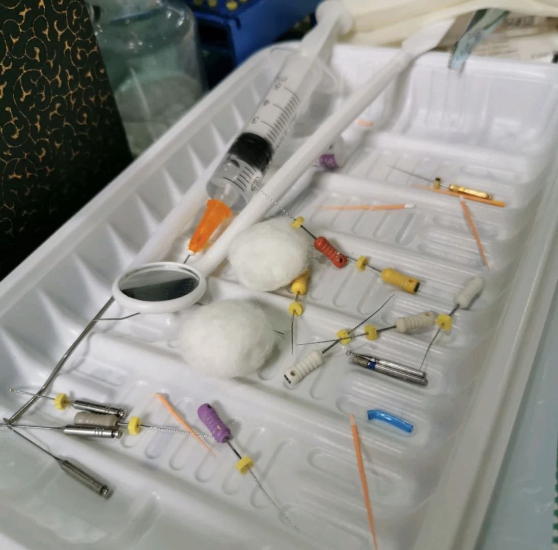 结果却被告知已经发展成了牙髓炎,要杀牙神经,做根管治疗.