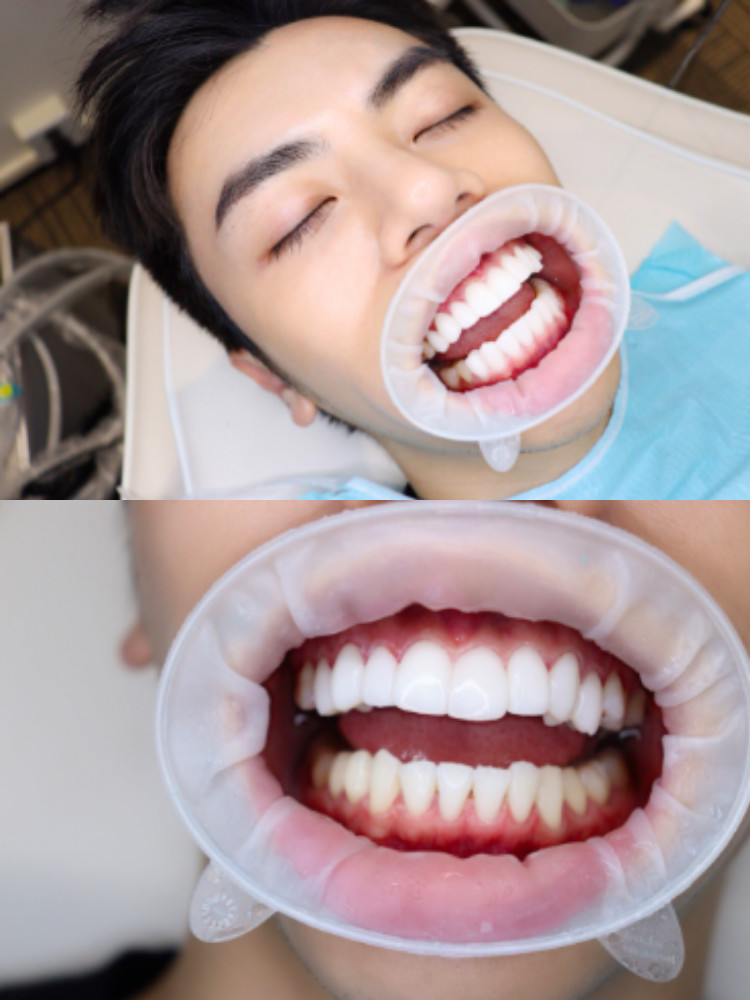 今天去做了全瓷牙贴面晒晒我的大白牙