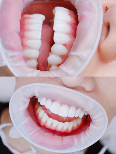 今天去做了全瓷牙贴面晒晒我的大白牙