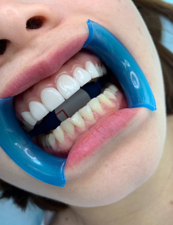 牙齿美白的三大误区大多数人都不知道