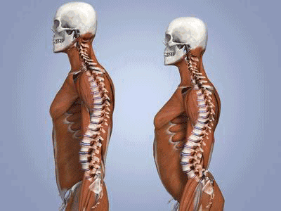 弯腰驼背会增加每一块脊椎骨之间的距离,有利于形成椎间盘向外突出,一