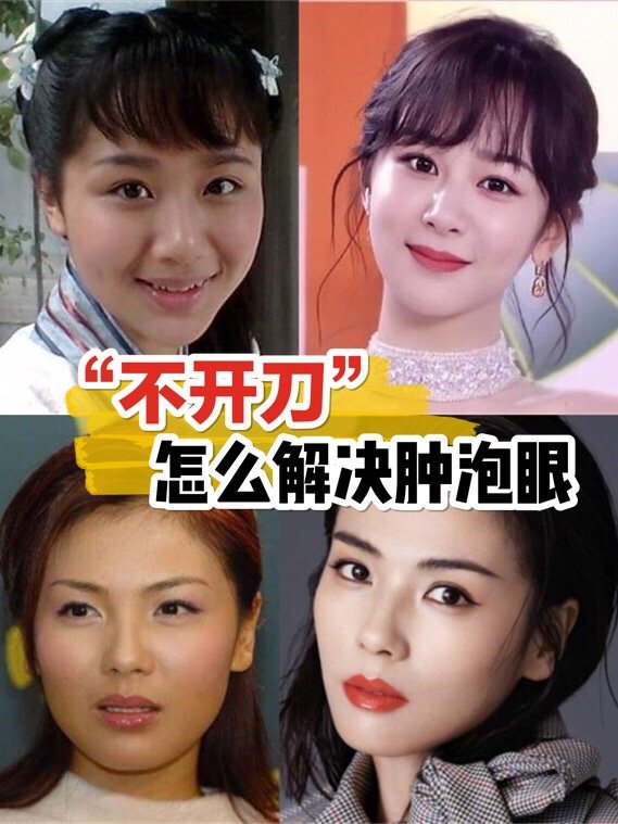 04杨紫和刘涛的肿眼泡,一个是整掉的一个是?