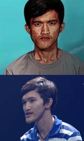 01鞋拔子脸逆袭小鲜肉,他都做了什么手术?