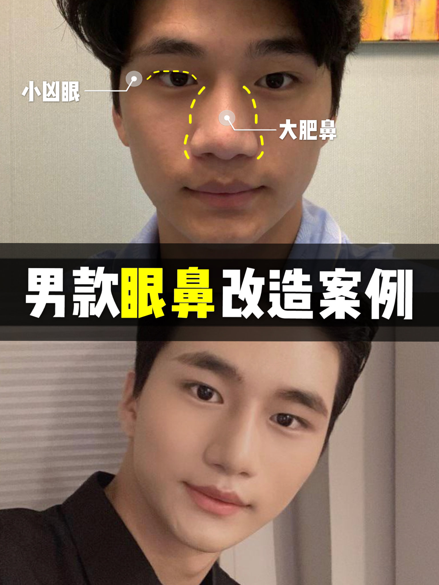 首页 此页面仅支持预览 Avatar 桃花peng 238篇日记 埋线双眼皮 鼻综合 男人也可以变得更优秀 千万不要把整形局限在女生身上 今天我看到个男生整形案例 他术后的样子就是我的理想型长相了 看看你们是不是也和我一样喜欢他嘿嘿 以下为这位小