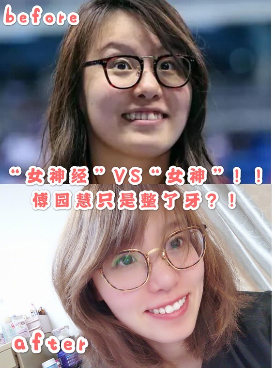 傅园慧"女神经"秒变"女神"!只是因为整了牙?