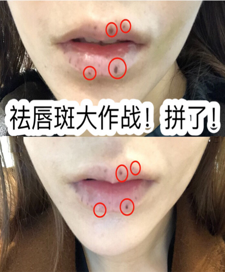 激光祛唇斑无美颜无滤镜真实分享