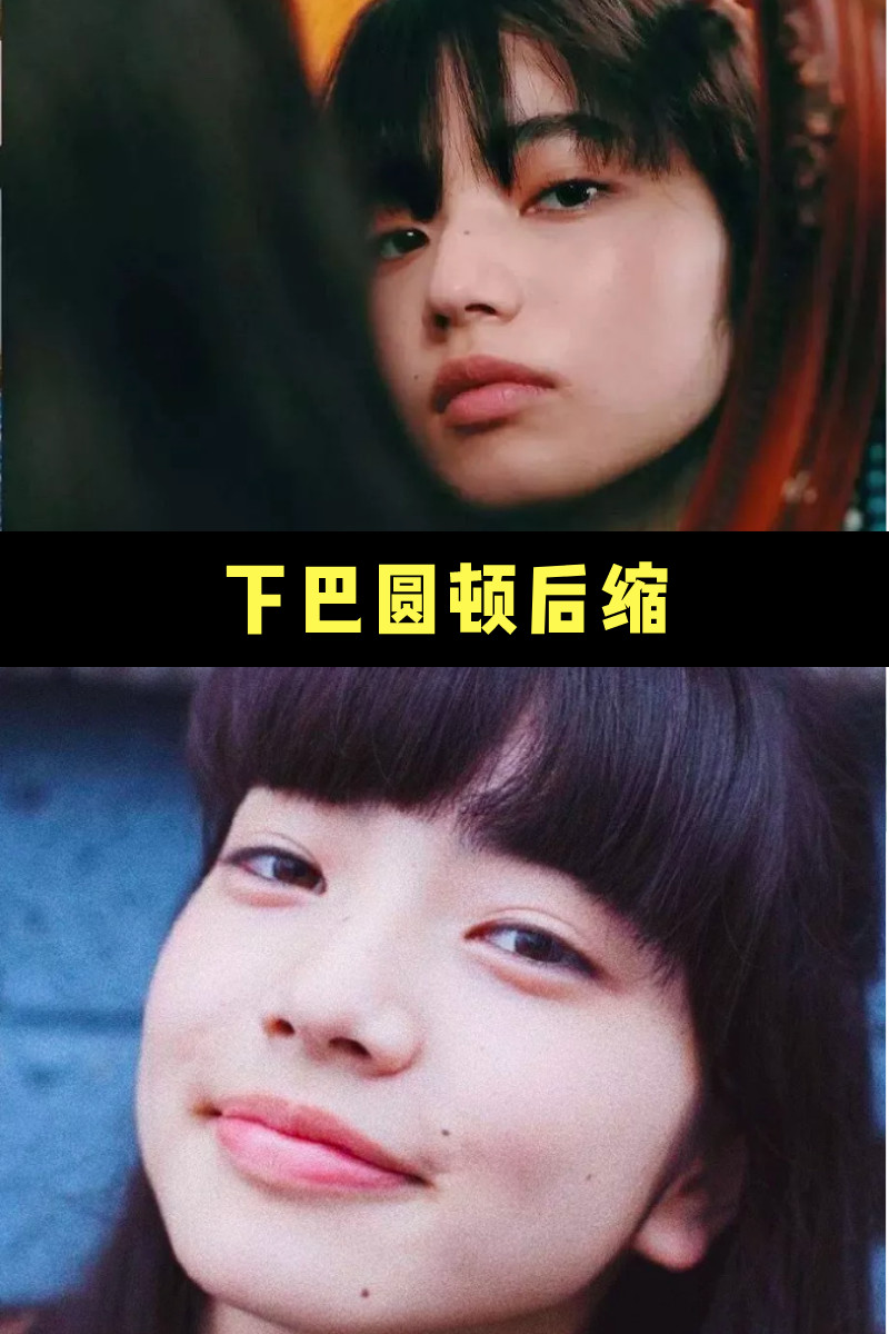 小松菜奈凭借嘴凸的厌世脸 泡到了菅田将晖 终于终 圈子 新氧美容整形