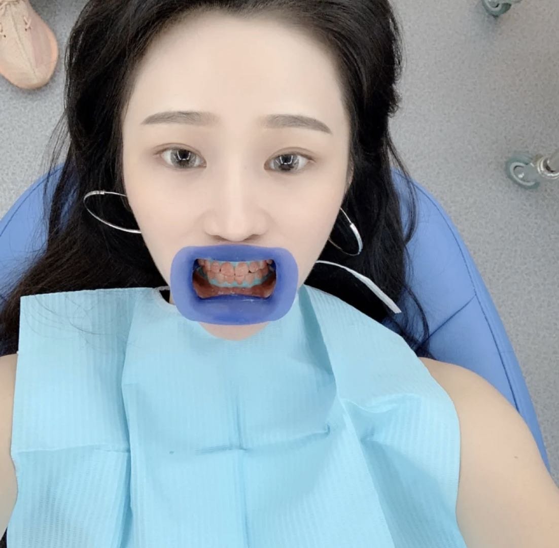 牙齿真的变白了皓齿美白我爱了!