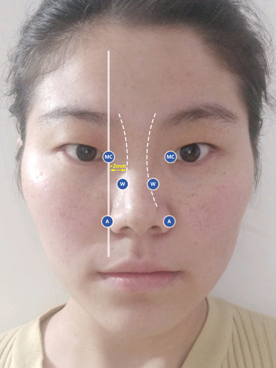 根据照片来看,你的鼻部偏短,山根偏低,鼻翼鼻背稍宽_圈子-新氧美容