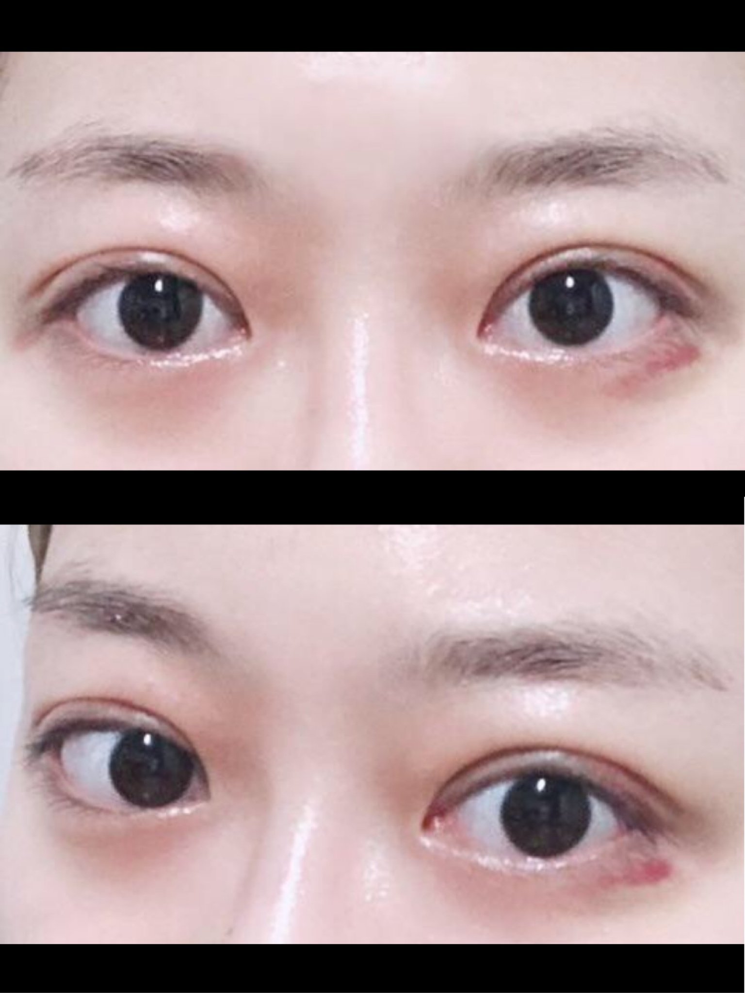 肿眼泡内双逆袭记