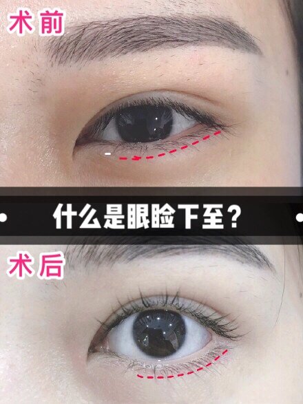 什么是眼睑下至究竟有何魅力能让众多日本女星都钟爱它