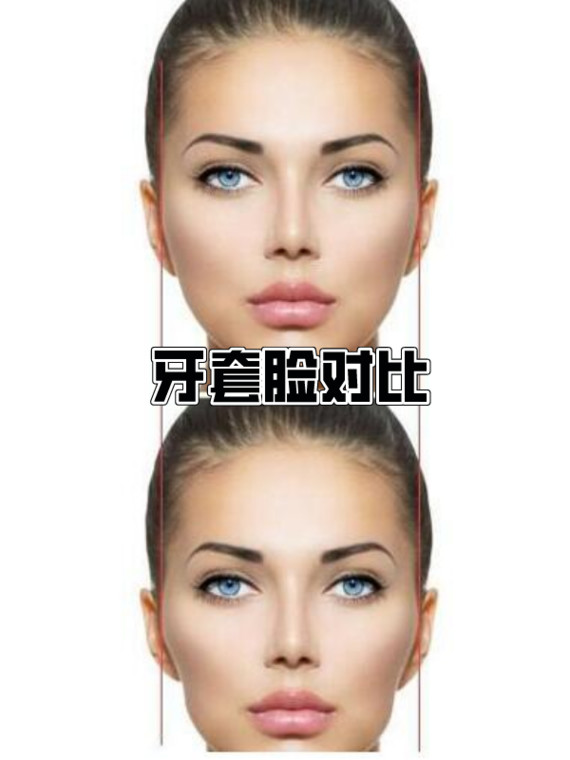 矫正就一定有牙套脸?