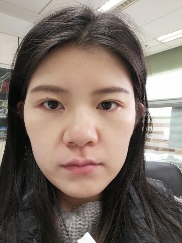 眼下的位置凹陷颧骨宽就显得面部有些下垂又显法令纹鼻头大鼻梁塌应该