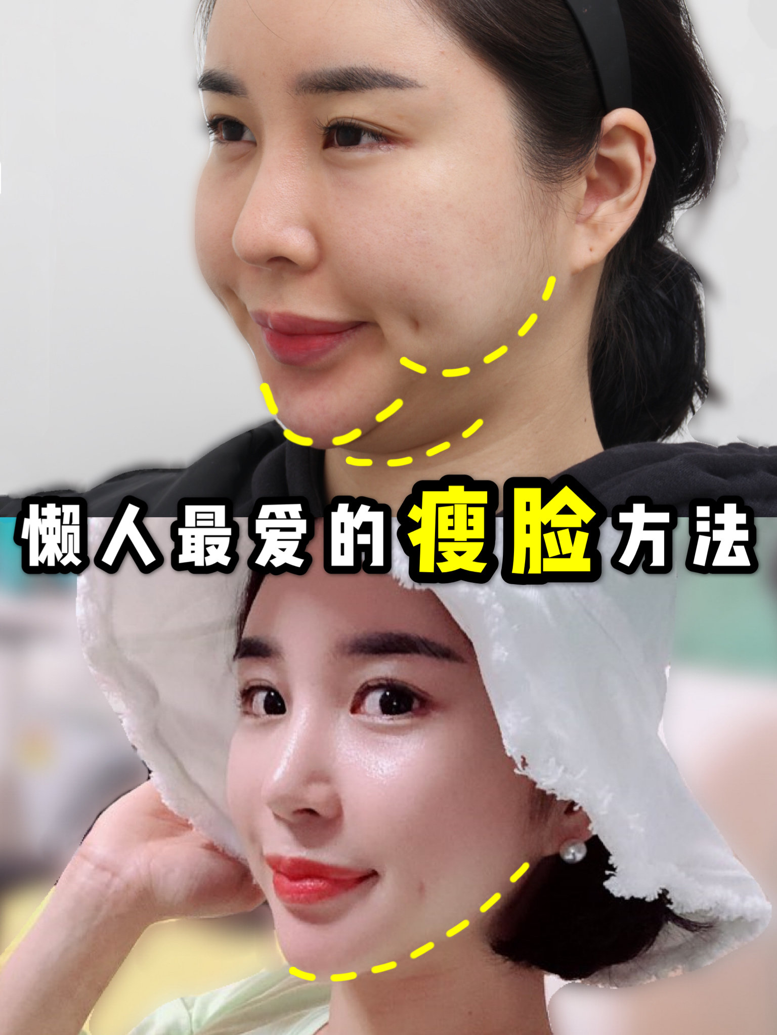 做了面部吸脂后轻松达成精致小v脸的目的