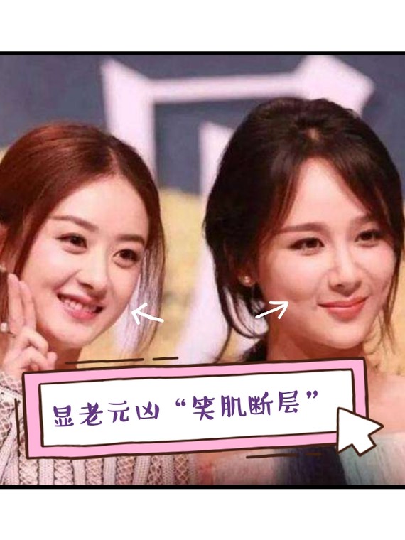 笑肌断层怎么办?上一篇讲了少女感的来源,略略带过_圈子-新氧美容整形