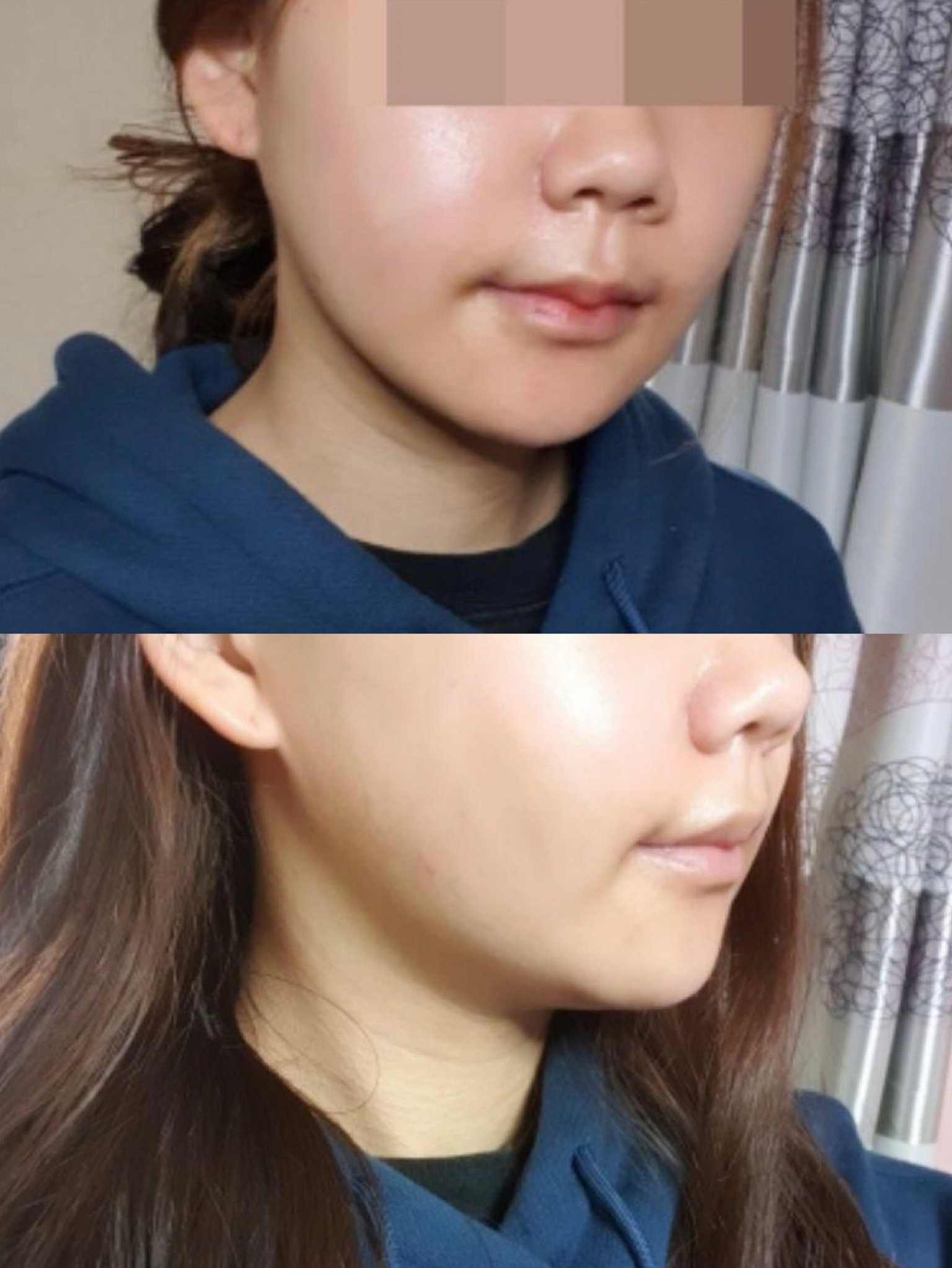 下颚前突矫正真人恢复全过程记录!