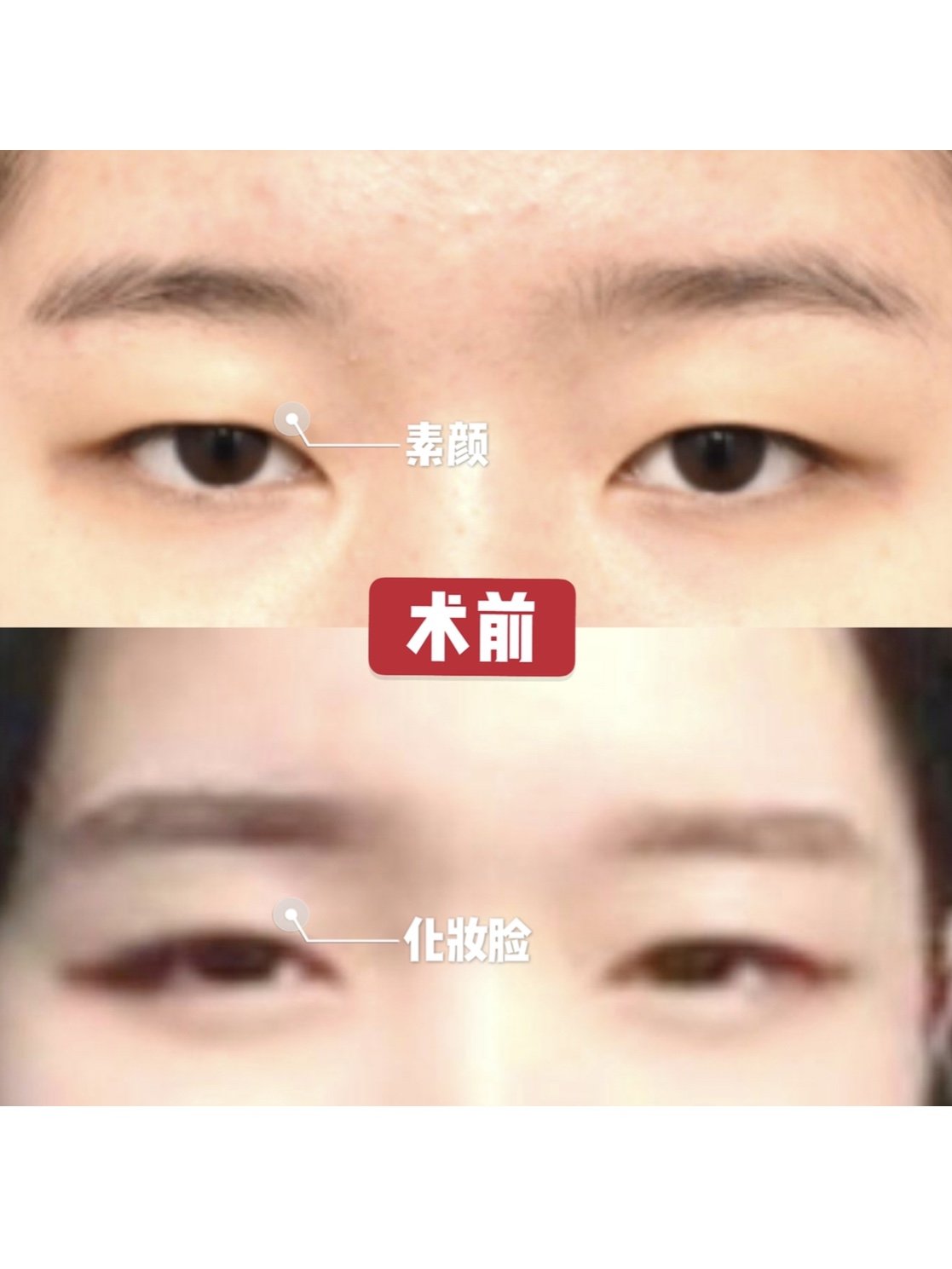 埋线双眼皮 上睑提肌,颜值提升不是一点点