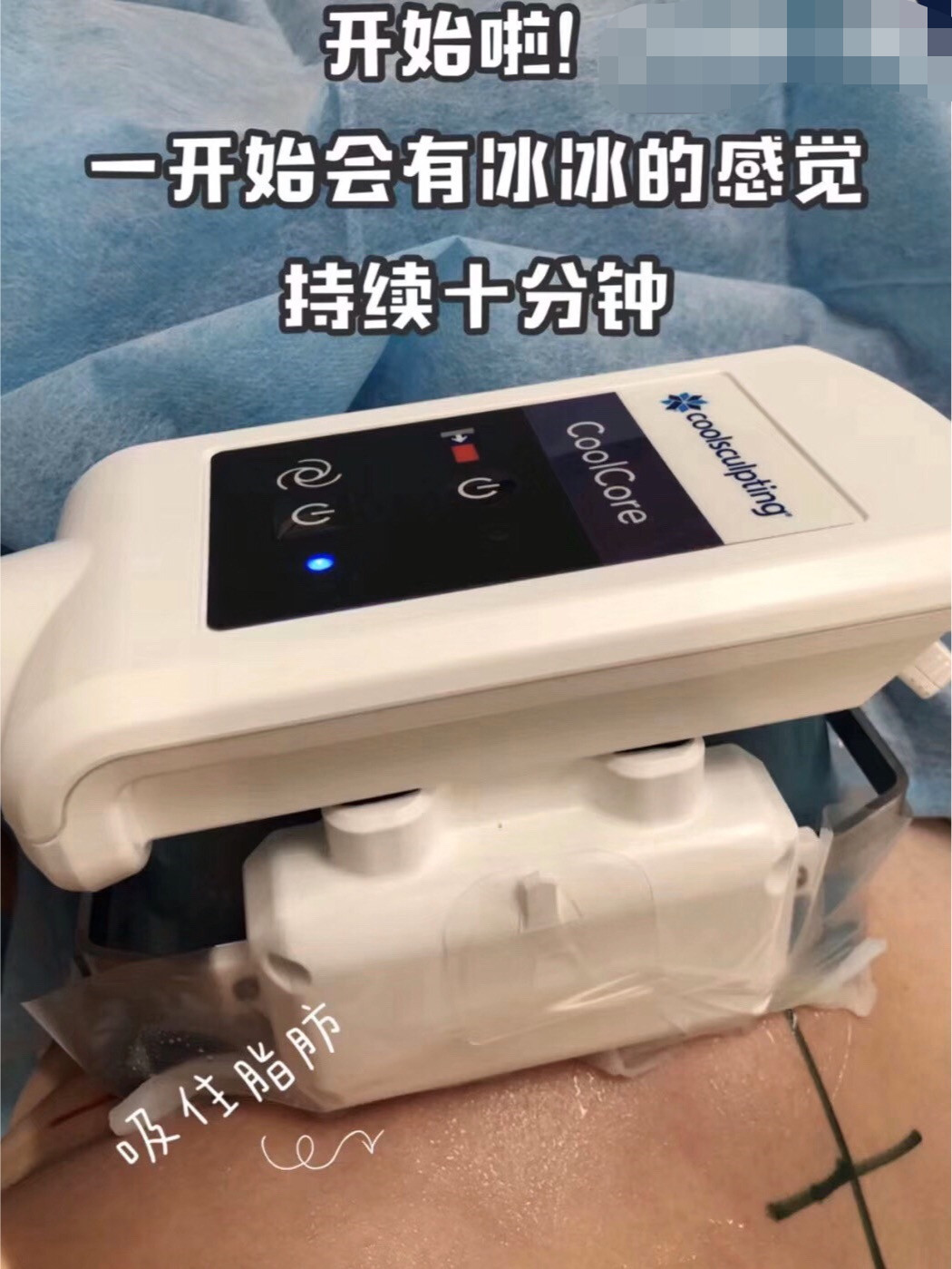 酷塑冷冻溶脂,亲测来啦