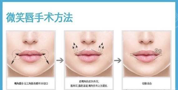 同时还要把嘴角的一个叫降口角肌的很细的肌肉组织切断,之所以需要把