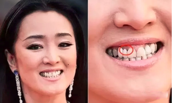 3,牙龈萎缩 烤瓷牙的正确的做法应该是把接缝藏到游离龈里面