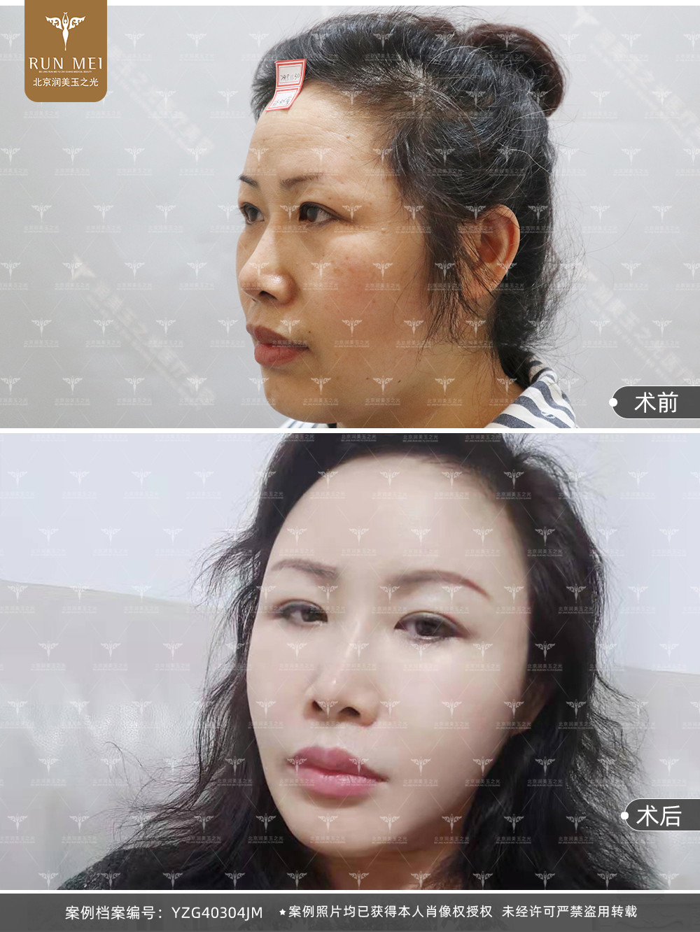 自体脂肪填充之后不自然怎么办?