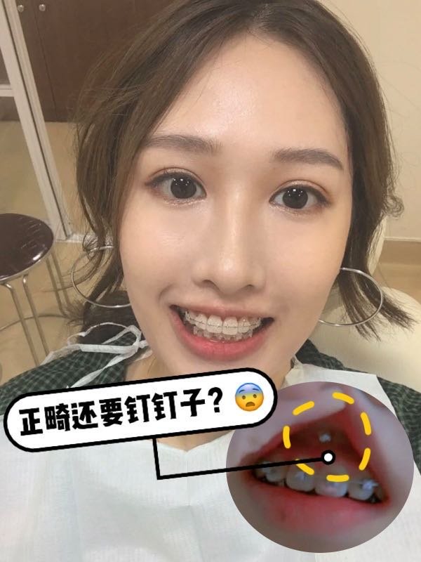 本来年前就要去打骨钉用于牵拉牙齿改善深覆合和露龈笑,但由于自己的
