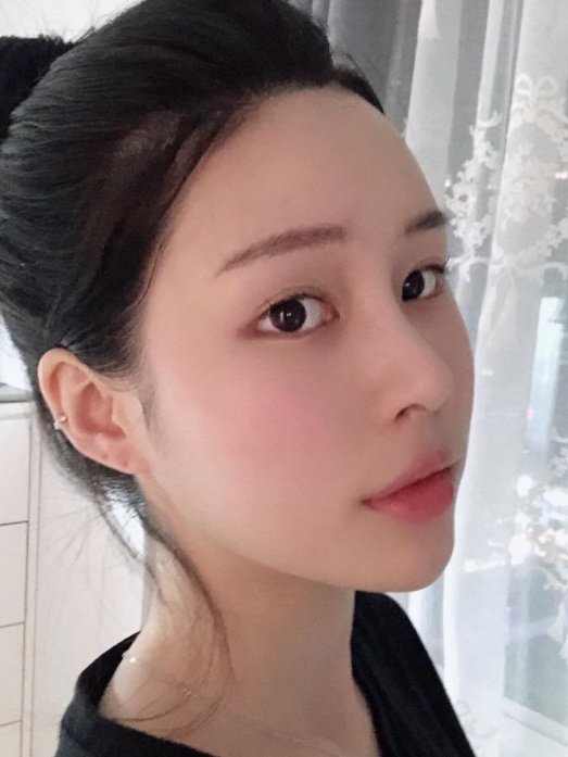 我被驼峰鼻困扰_圈子-新氧美容整形