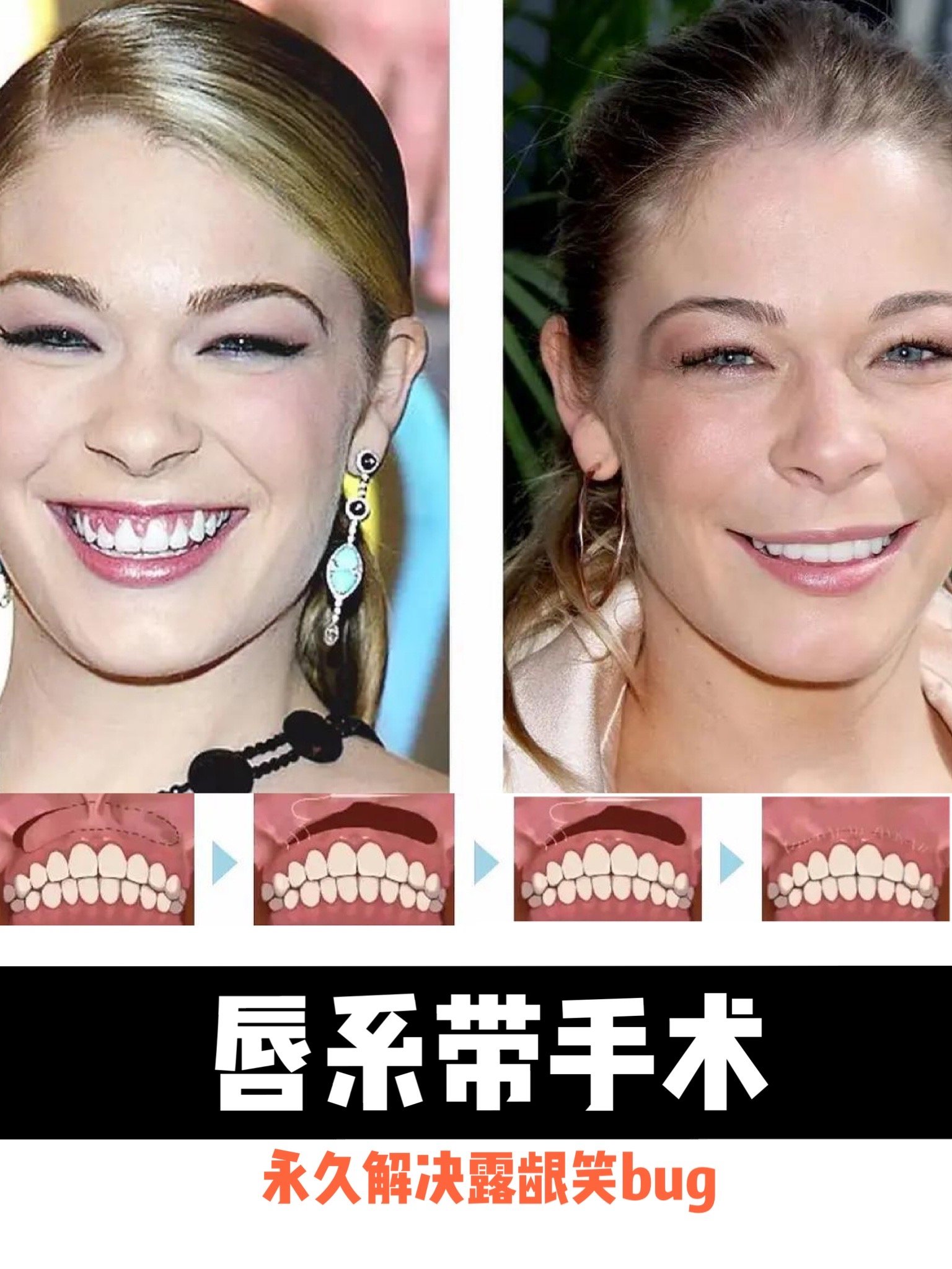 其实也do过切牙龈手术 之所以没人察觉到是因为天仙的露龈笑bug并没有