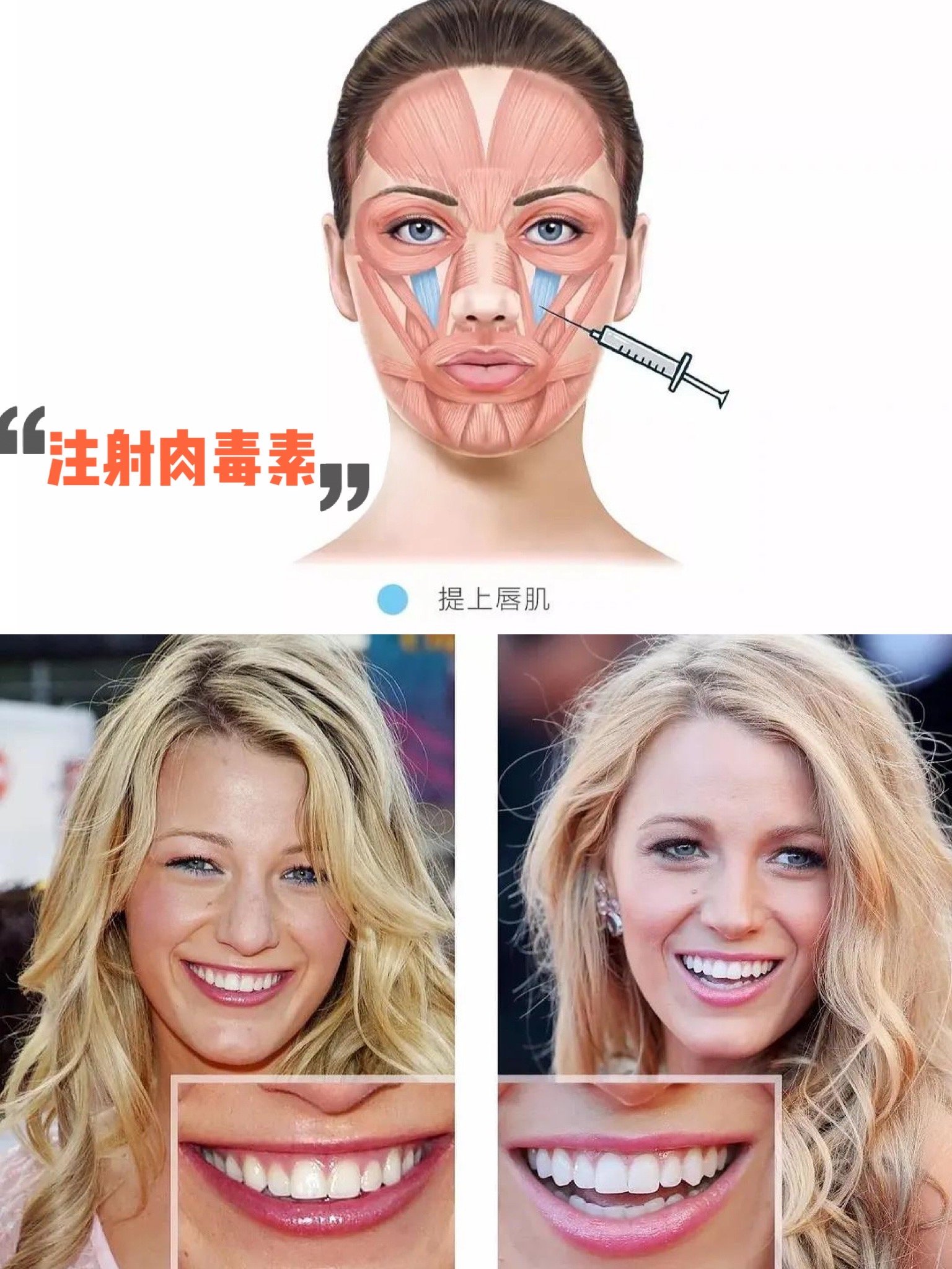 提上唇肌力量过大  如果提上唇肌力量过大,牙龈