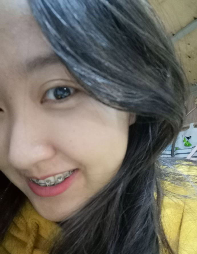 虎牙妹妹矫正前后对比